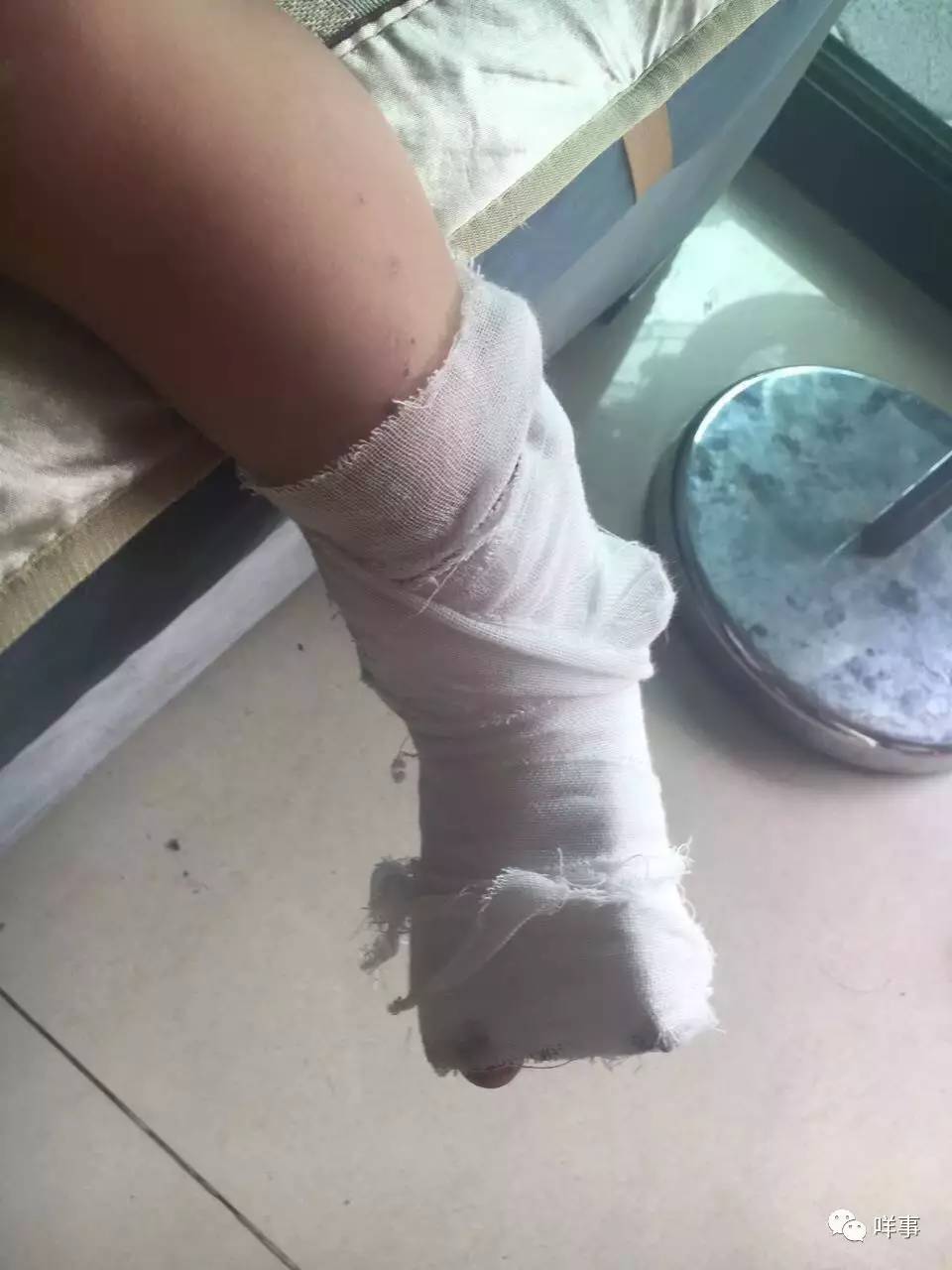 小明左脚需要打石膏休养三个月. 受访者供图
