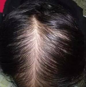 男人脱发=肾虚?脱发,秃顶,切忌盲目补肾,你可以这么治!