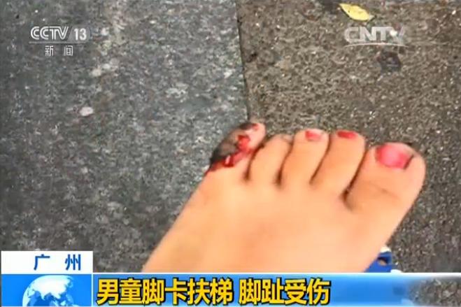 男童脚卡商场电梯侧缝 导致脚趾骨折