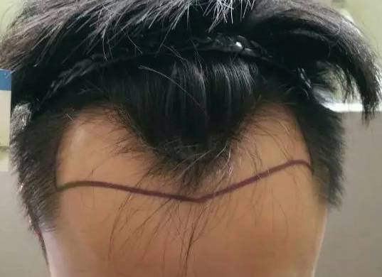脱发 秃顶 M型脱发 遗传性脱发 如何拯救 手机新浪网 脱发 秃顶 M型脱发 遗传性脱发 如何拯救 手机新浪网