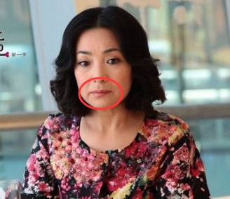 年龄增长,面部胶原蛋白大量流失,皮肤松弛,肌肉,韧带松弛造成嘴角凹陷