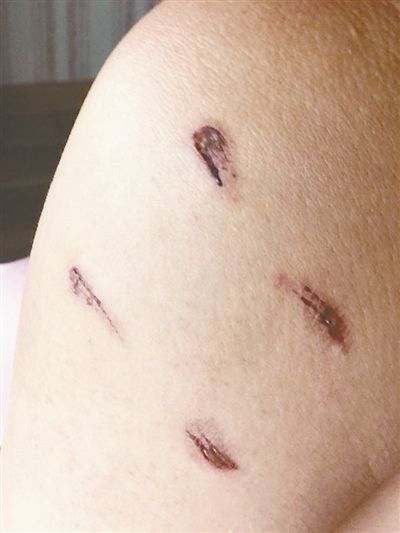 男子驾车游八达岭动物园被熊咬伤 否认向园方讹钱