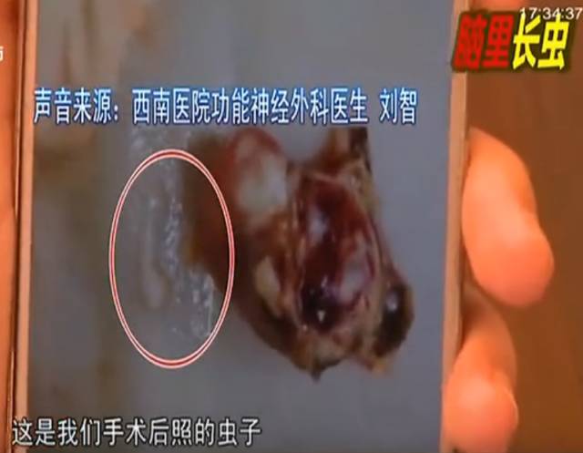 少女大脑皮层萎缩医生从她大脑里活捉出虫子这些事一定要注意