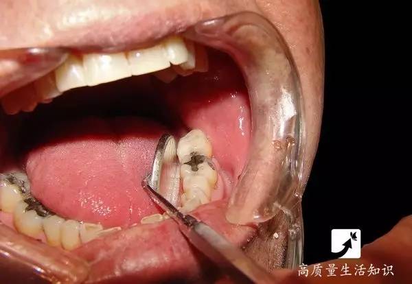 不仅会引起牙疼,牙周炎之外 也会带来口臭,口苦等 牙龈,舌头,唾液腺等