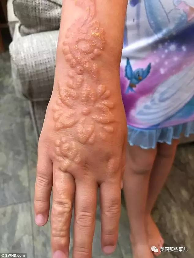 7岁女孩一时爱美涂上这个后被送去急救|过敏|海娜|纹身_新浪育儿_新浪