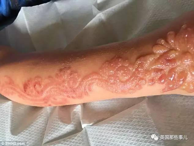 7岁女孩一时爱美涂上这个后被送去急救|过敏|海娜|纹身_新浪育儿_新浪