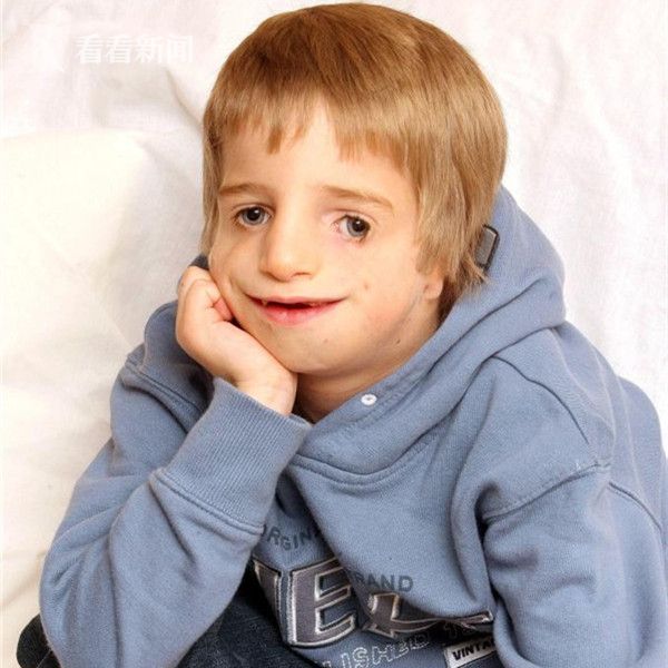 视频英国男孩天生脸部畸形每天都要打断下颚骨整形