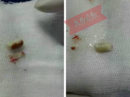 1岁大的孩子左肺"消失",直接住进icu抢救,罪魁祸首