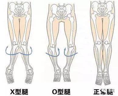 正面看是不是会特别不直,更严重的会膝外翻造成x型腿,膝内翻造成o型腿