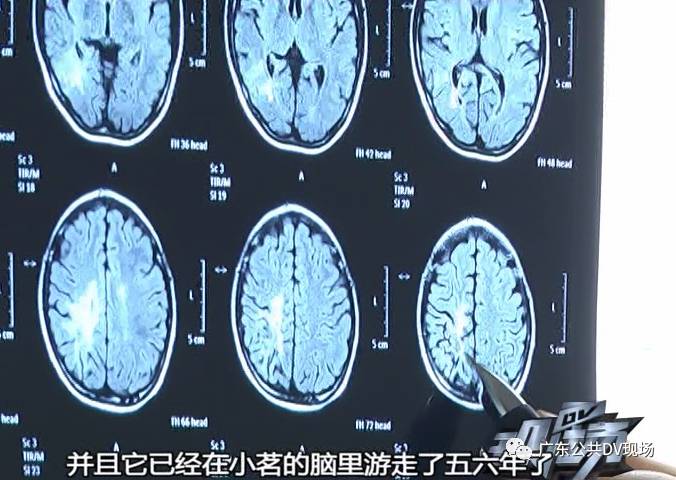 恐怖25厘米长寄生虫长在12岁女孩大脑里脑中游走五年挖隧道