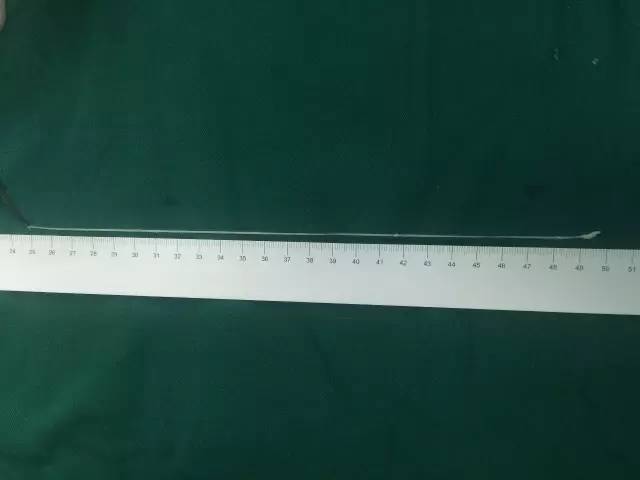 女孩数次晕倒口吐白沫,一条25厘米寄生虫在大