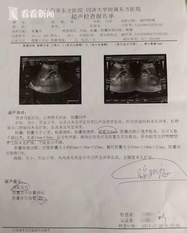 内脏180度跑偏罕见镜面少年成功切除胆囊