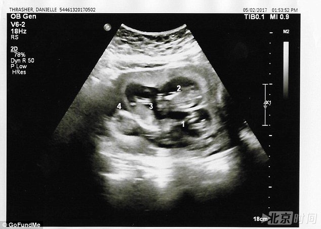 女子怀上四胞胎却面临最艰难选择|四胞胎|双胞胎|怀孕_新浪新闻