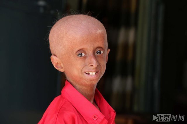 印度11岁男孩患有早衰症 样貌如60岁