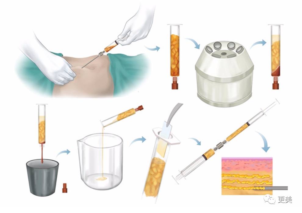 因为是自身的脂肪细胞所以注射到面部的话没有排异反应,安全度高,而且