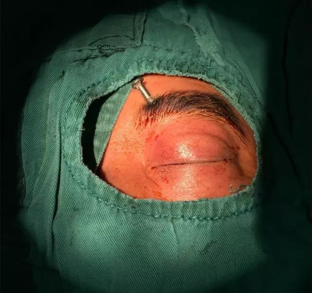 飞来横祸,6厘米长钉子穿透土工眼球,装修必读