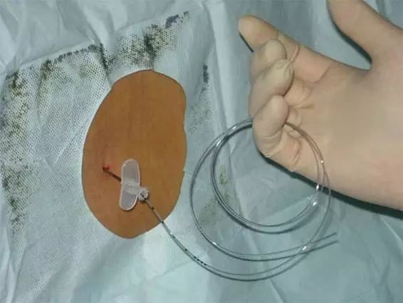 宫口终于开到三指,也幸运地等来了麻醉师打无痛分娩, "有点像打吊针