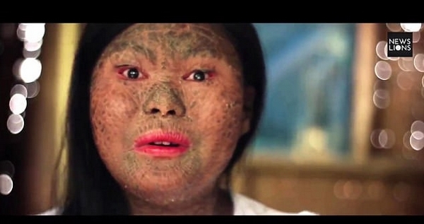 菲律宾女子全身长满鳞屑被嘲笑为蛇皮女