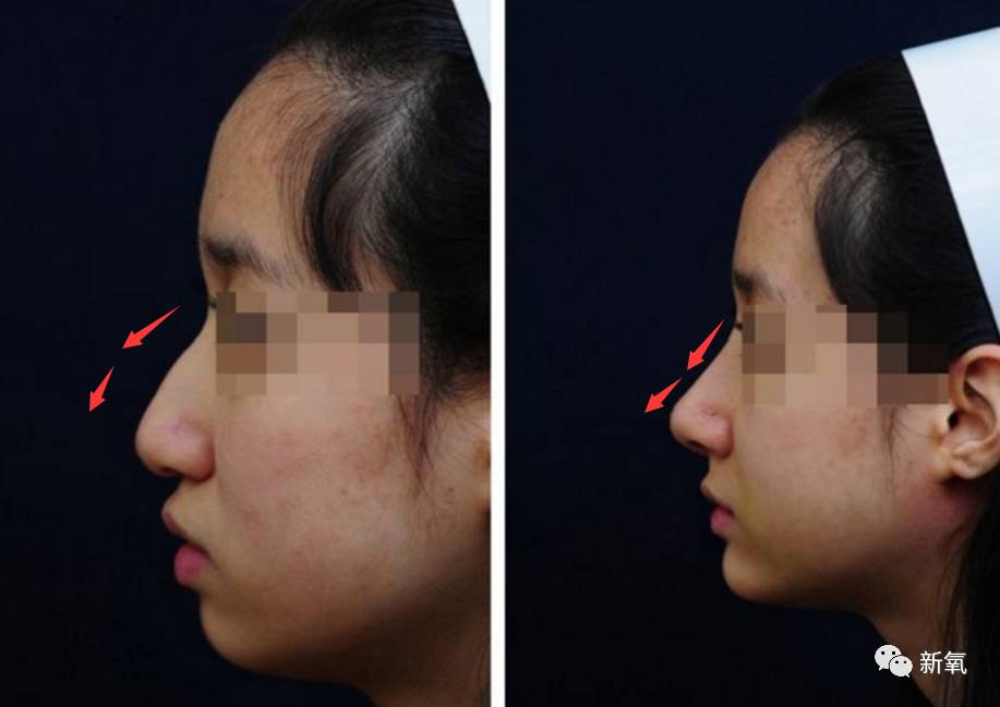 娜扎居然把驼峰鼻磨掉了鼻尖像被镰刀削过