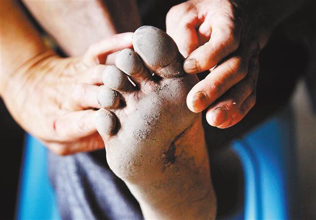 由于曹树才长期赤脚走路,脚上已经全是老茧.