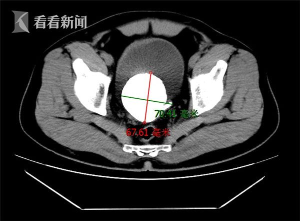 外院超声检查发现左肾,输尿管,膀胱多发结石