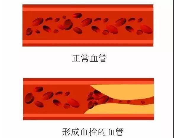 【健康】10秒钟“清理”你的血管!血栓最怕这个动作|糖尿病|血栓|血管_新浪新闻