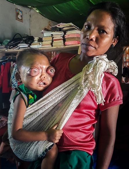 印2岁男童患罕见眼癌眼球外凸似外星怪物