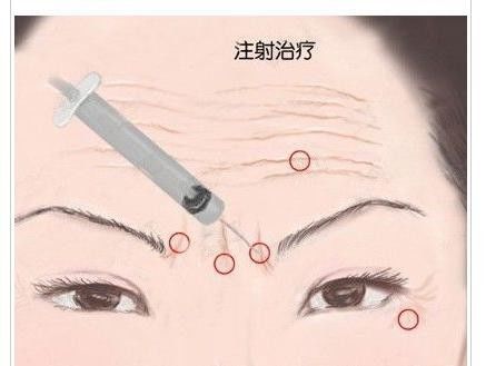 肉毒素注入产生皱纹的某些表情肌肉内,会阻断神经递质乙酰胆碱的释放