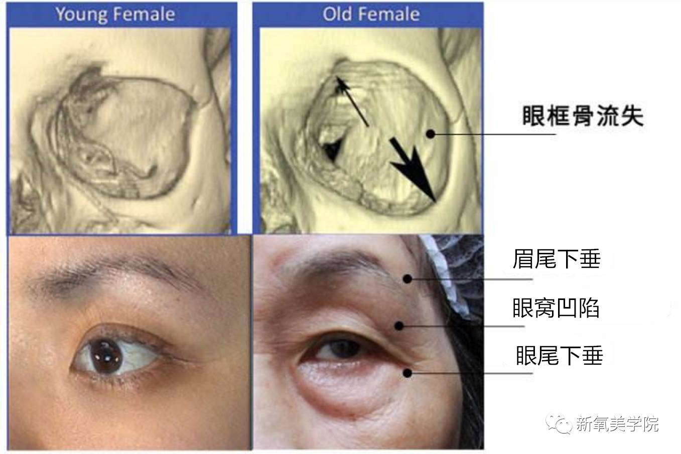 会变大,变大后软组织失去支撑,就会带来眉尾和眼尾的下垂以及眼窝凹陷