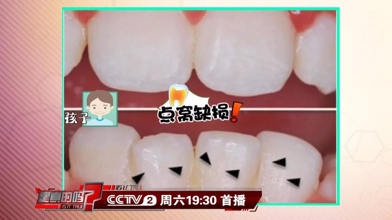 复杂,目前单纯从牙齿来说,常见的遗传性疾病有遗传性牙本质发育不全