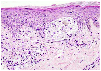 黑色素瘤研究进展一览