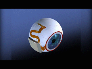 视网膜也可以人造看这个技术如何帮助盲人重获光明丨媞问创新