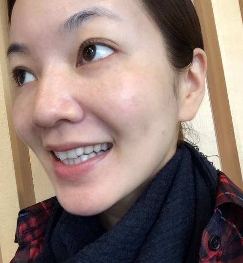 baby拔了智齿戴了整形牙套牙齿大了之后个别角度有点撞脸王珞丹有木有