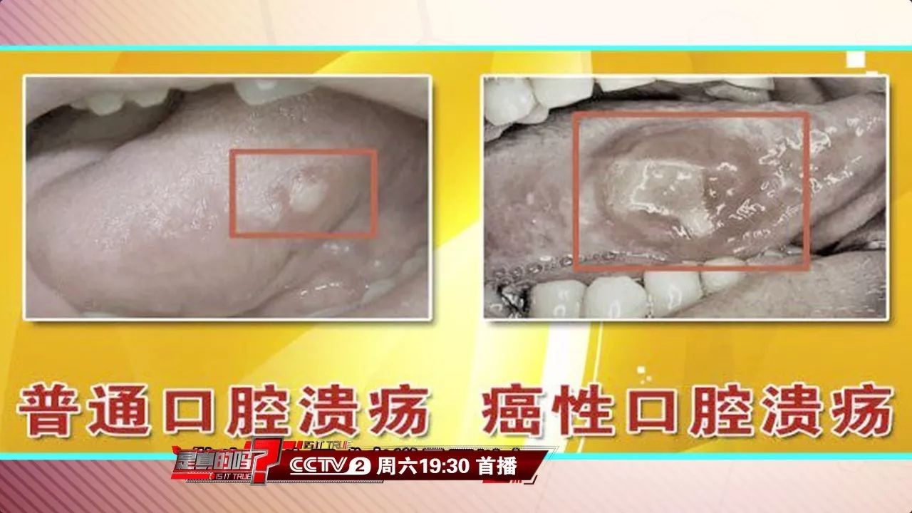 千万别大意→|口腔溃疡|溃疡|口腔癌_新浪新闻