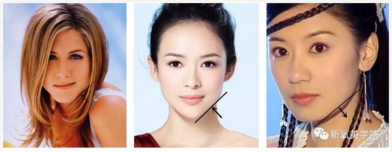 郭碧婷现在凸嘴 下巴后缩,是戴牙套造成的吗?
