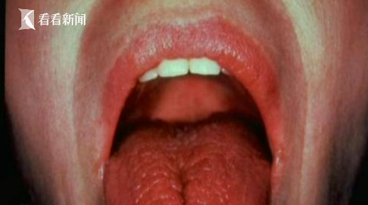 舌头根部长溃疡图片图片