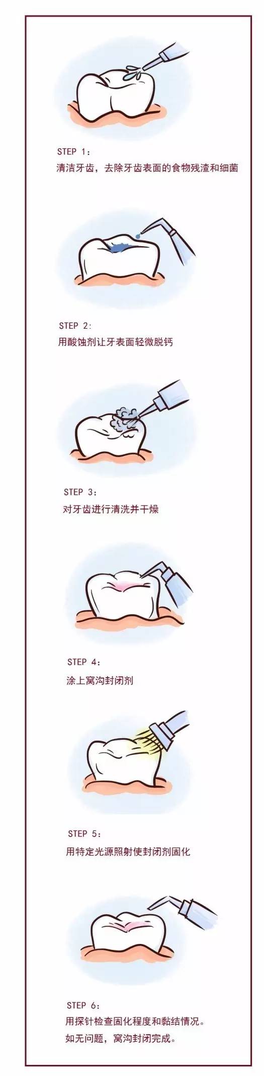 窝沟封闭只适用于健康的牙齿,或者有轻微腐蚀的牙齿,有明显蛀牙的牙齿