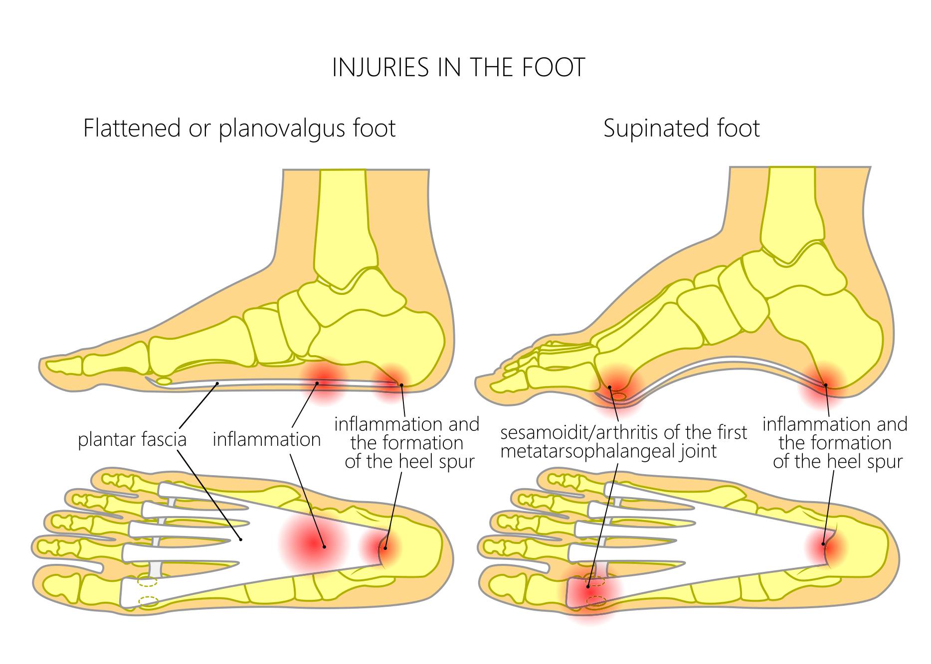 关节|韧带|足底_新浪新闻