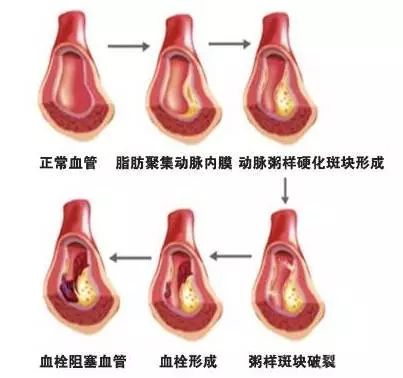 45å²åŽ å¸¸åƒè¿™ä¸¤ç§é£Ÿç‰© è½»æ¾åŒ–è¡€æ 