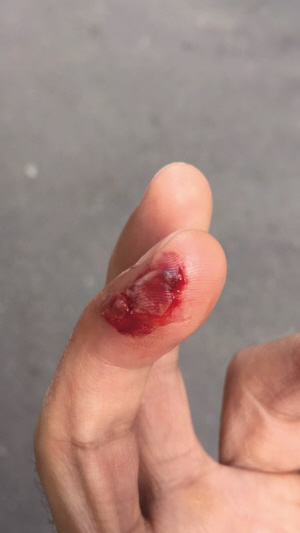 手破了社区医院未必都能看