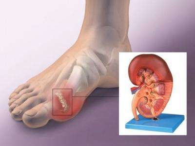 20岁大学生半夜喊脚疼一查竟是痛风