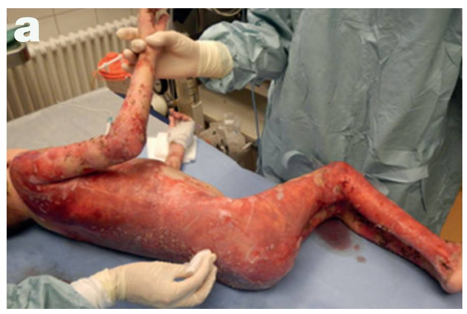 基因疗法用2个月替换病人80的皮肤