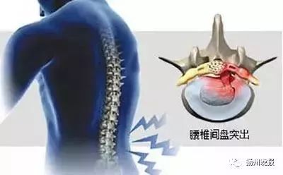 当心!24岁女子喝水喝出急性腰扭伤!这个病已经