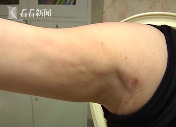 视频12万做微塑抽脂女孩术后腹部不对称手臂凹凸不平