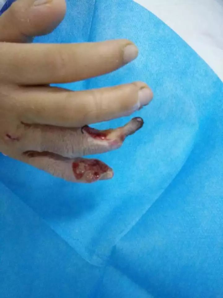 南宁10岁男童被截肢,只因为触碰了每个小区都有的这个东西!