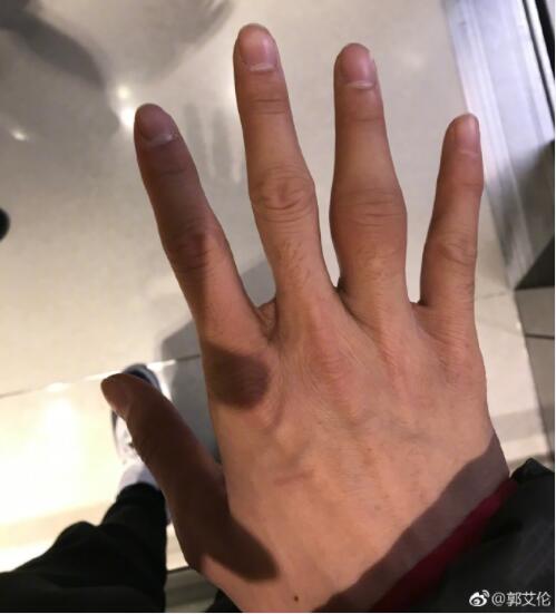 郭艾伦晒手指受伤照片:在困境中坚强