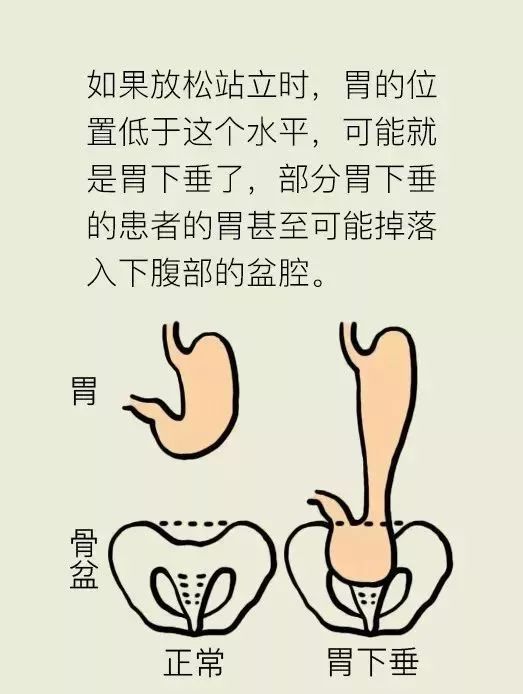 "饭后运动会胃下垂"的传说到底是不是真的?