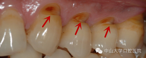 依程度可造成牙齿敏感,牙髓炎甚至牙齿横折,刷牙方法(如拉锯式)不正确