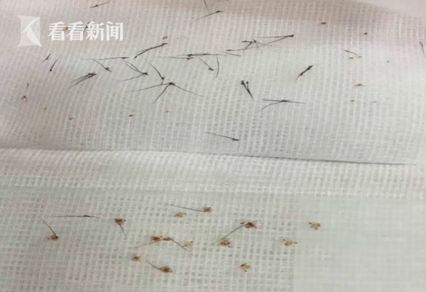 视频睫毛根部长满吸血活虫大妈眼痒四个月医生此虫多寄生于隐私部位