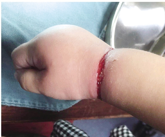 就是这根橡皮筋嵌入孩子手腕.